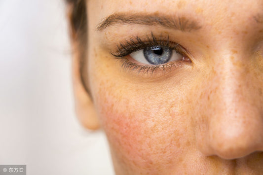 How to Effectively Cover Melasma with Makeup: Expert Tips and Techniques